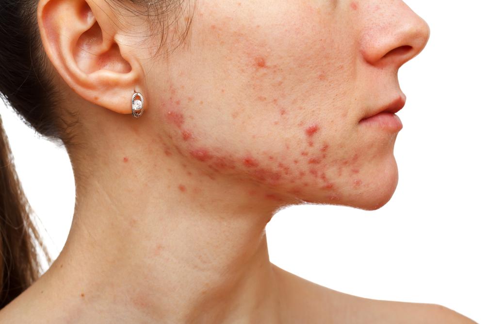 Comprehensive Guide to Recognizing Eczema Symptoms and Types