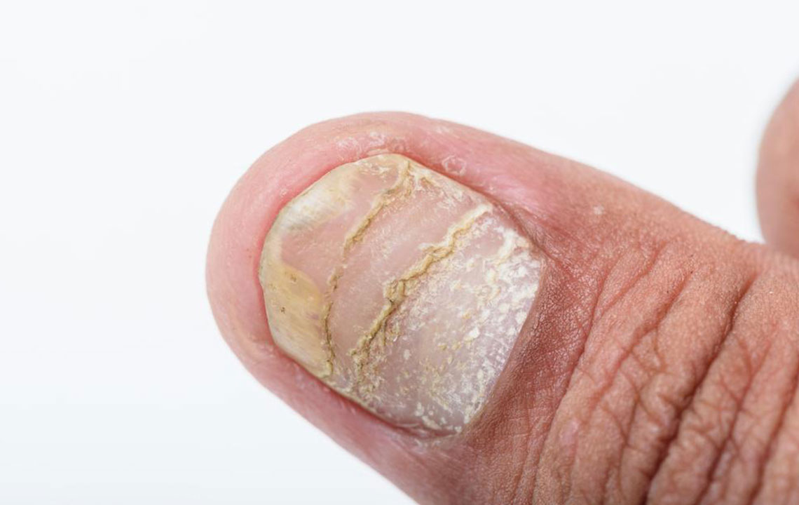 Common Nail Disorders and Their Underlying Causes