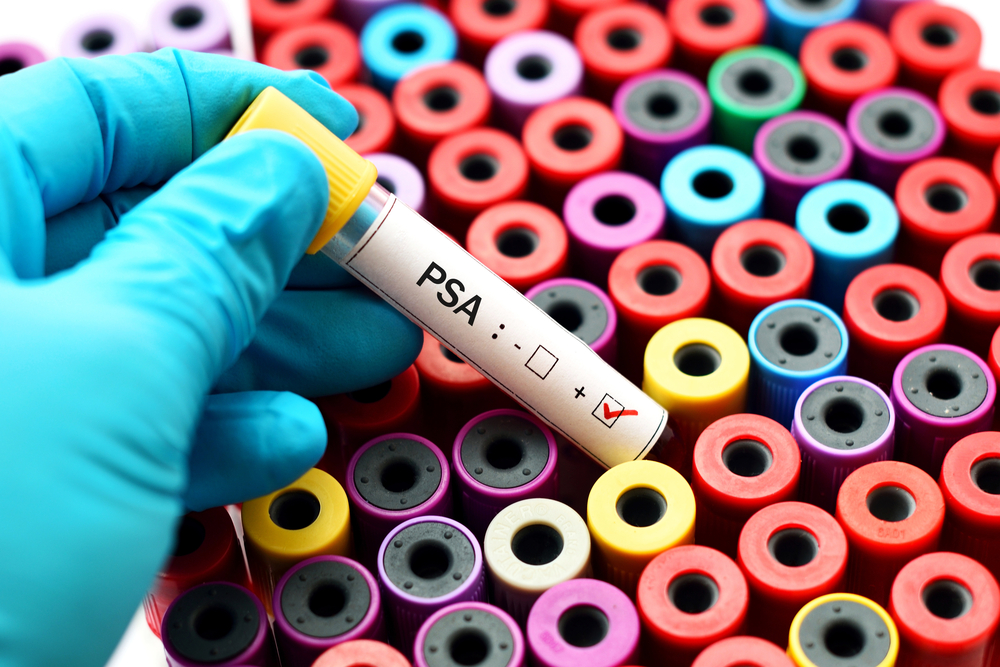 Causes and Significance of Elevated PSA Levels in Men