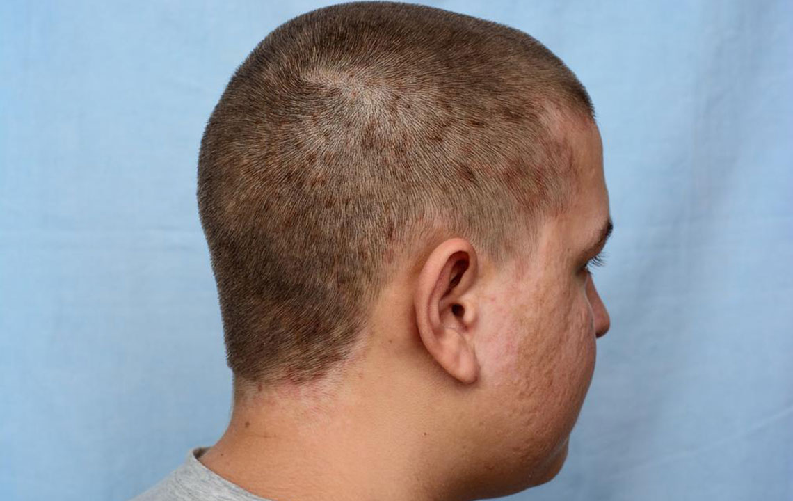 Understanding Atopic Dermatitis: Causes and Treatment Options