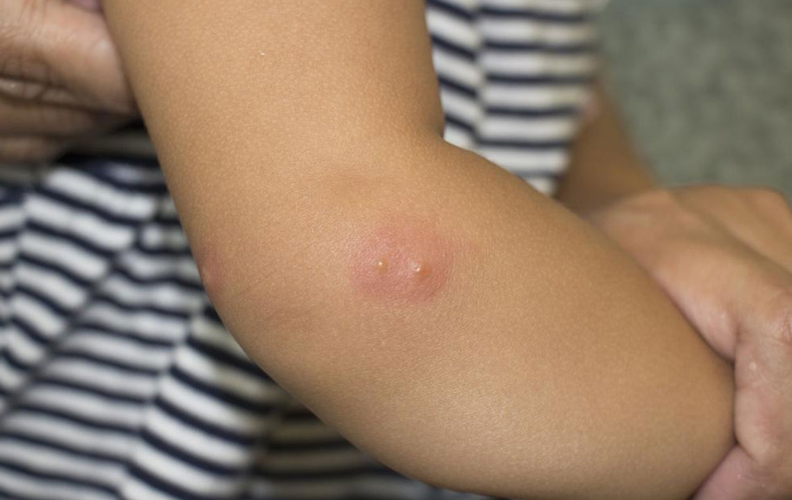 Essential Guide to Recognizing and Managing Shingles Symptoms