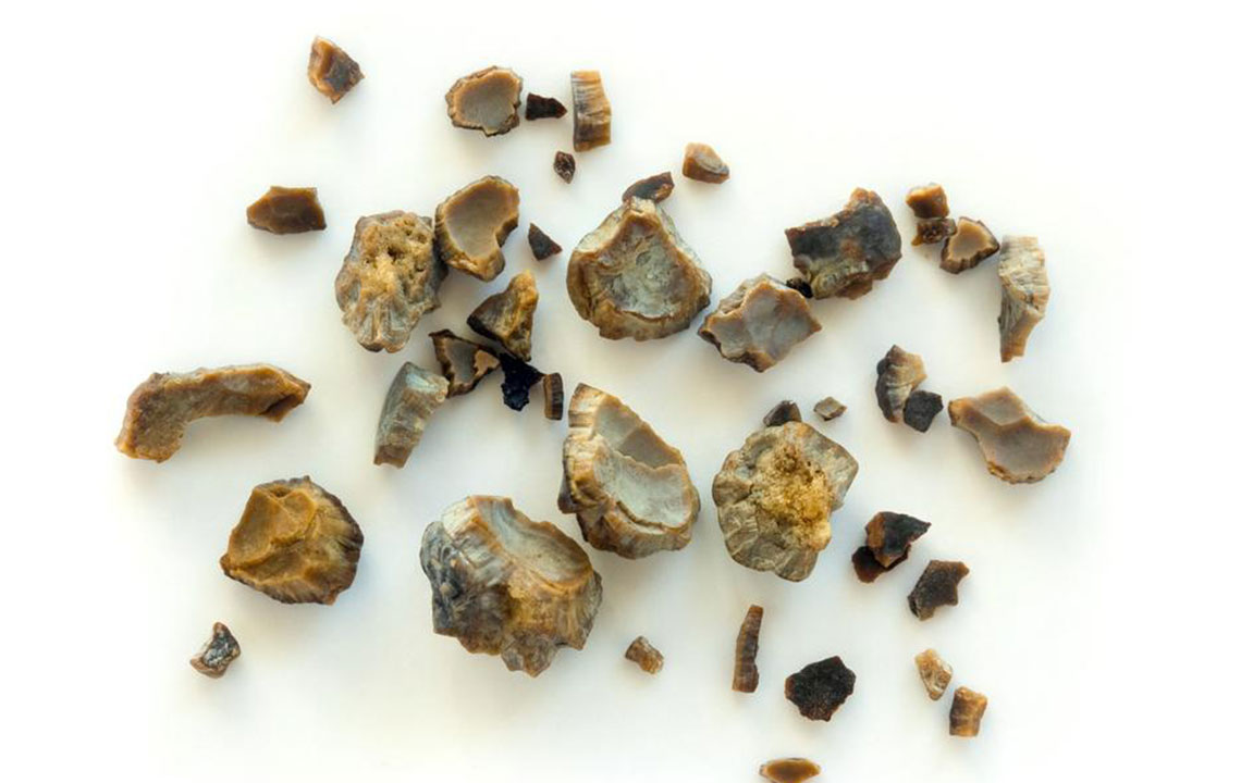 Comprehensive Guide to Uric Acid Kidney Stones: Causes, Risks, and Effective Treatments