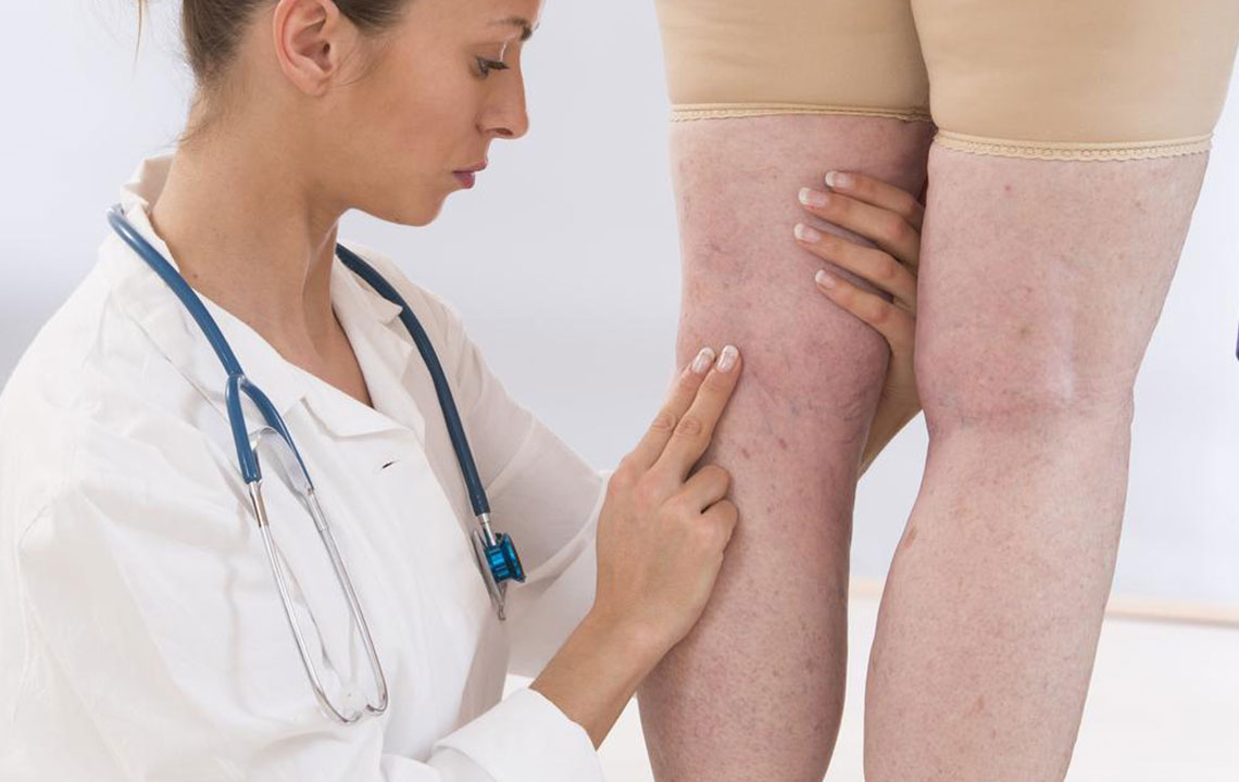 Effective Strategies for Managing Varicose Veins