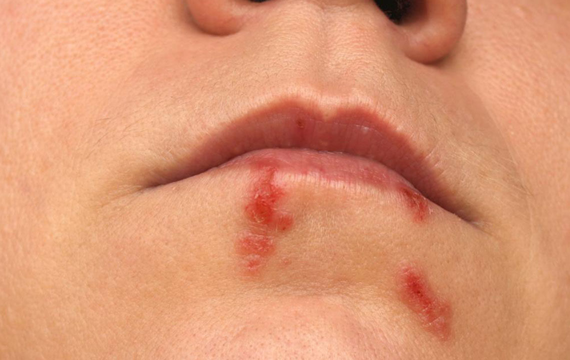 Top Home Remedies and Treatments for Cold Sores