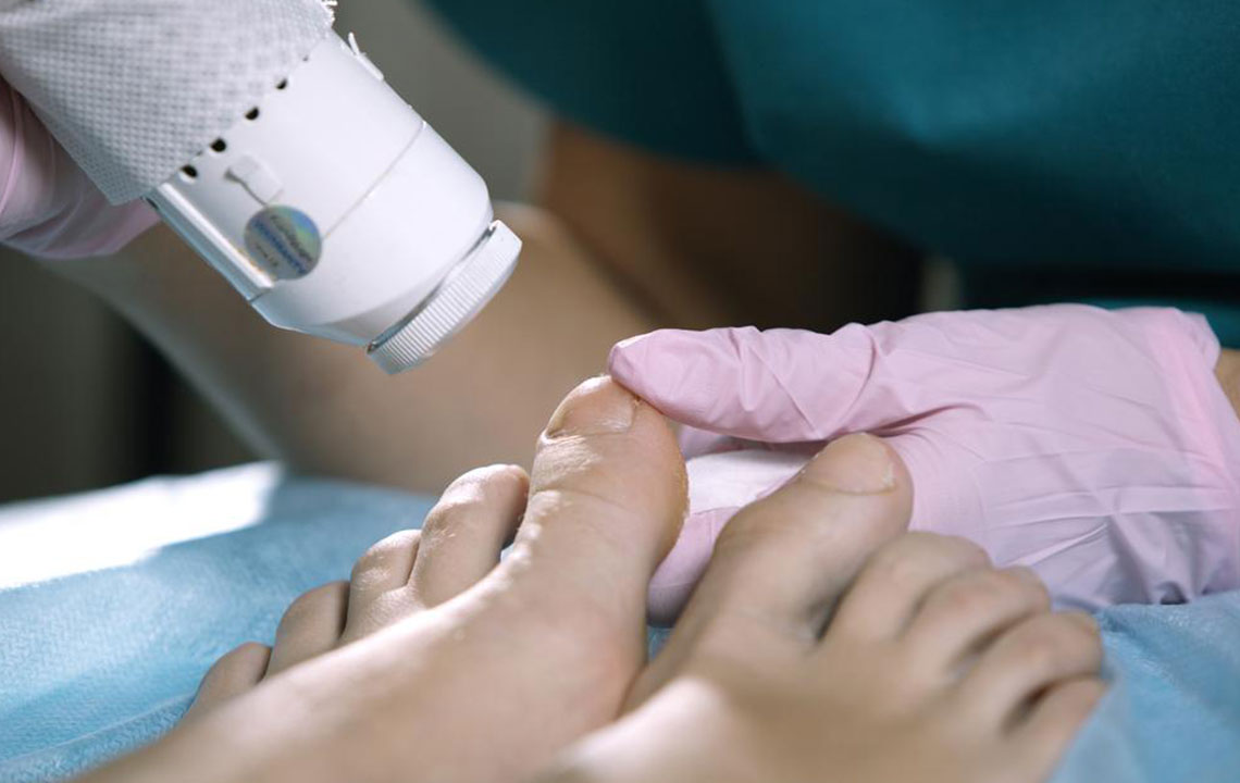 Key Insights into Treating Nail Fungal Infections