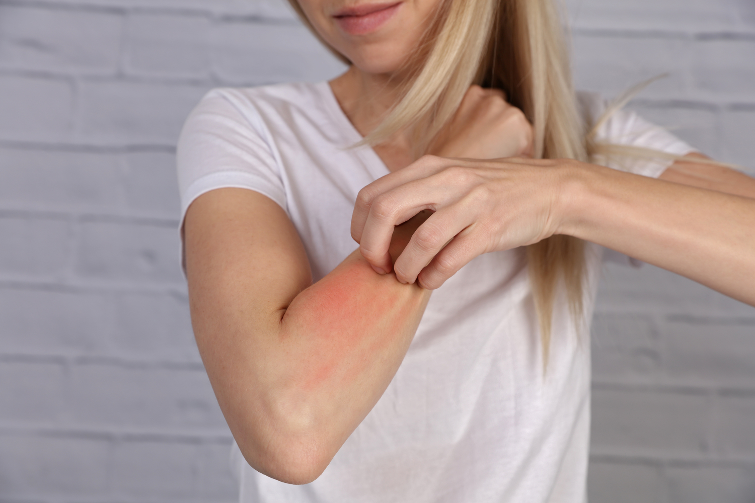 Comprehensive Guide to Psoriasis Treatments: Effectiveness and Side Effects