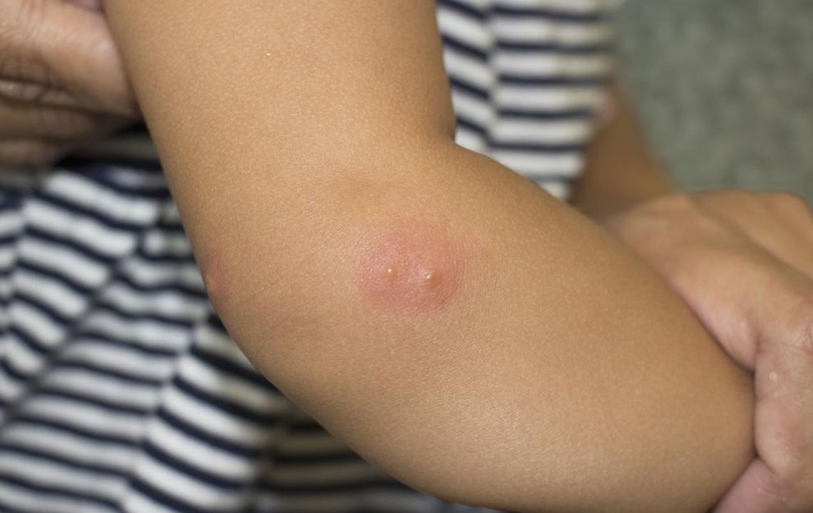 Top 4 Over-the-Counter Remedies for Managing Shingles Discomfort