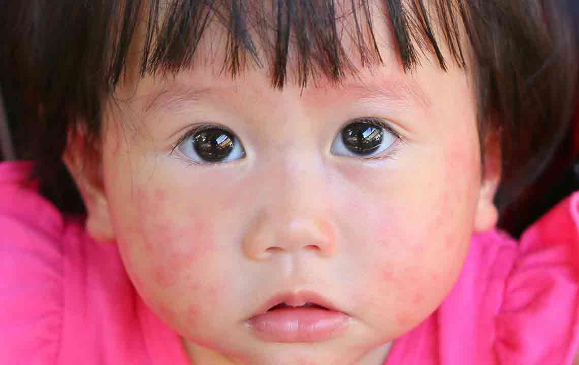 Recognizing Common Signs of Mold Allergies You Should Be Aware Of