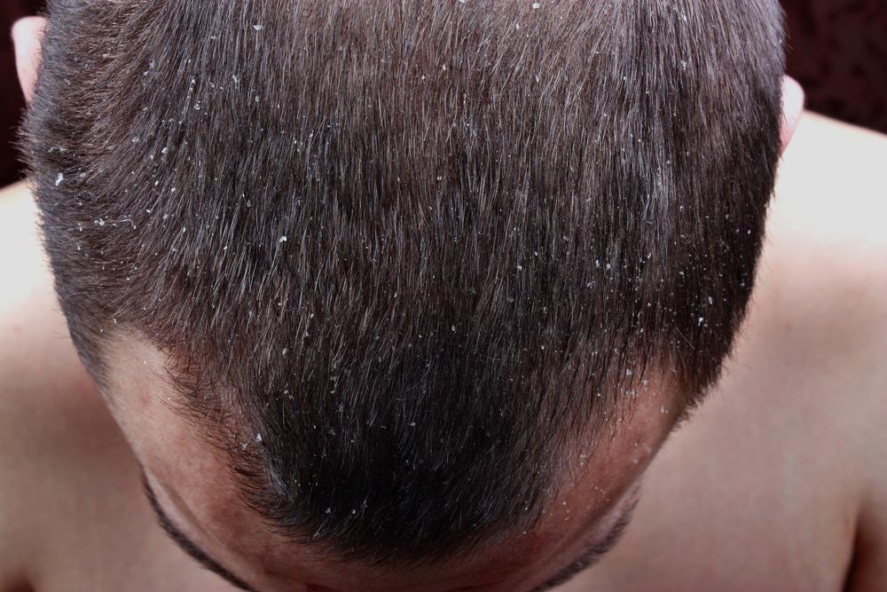 Understanding Scalp Psoriasis: Causes, Symptoms, and Treatment Options