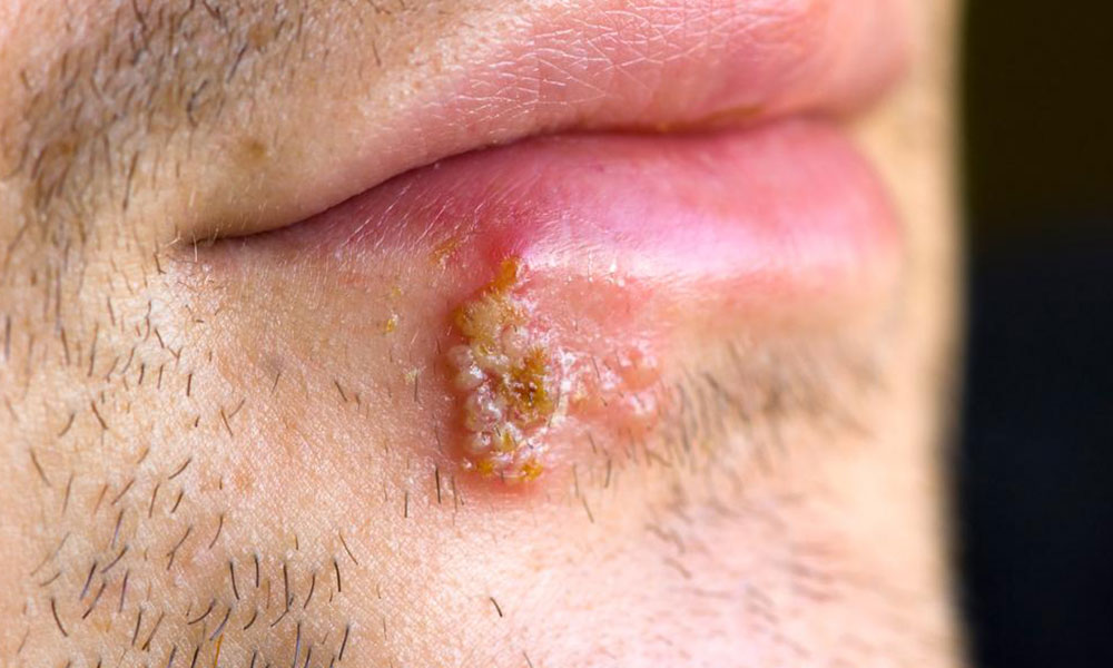 Understanding Blisters: Causes and Effective Ways to Speed Up Healing