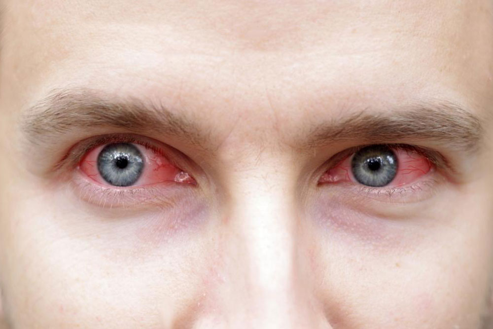 Effective Strategies for Managing Sjogren's Syndrome Symptoms
