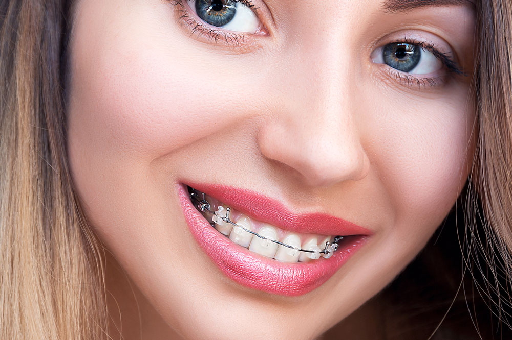 Essential Tips to Know Before Getting Dental Braces