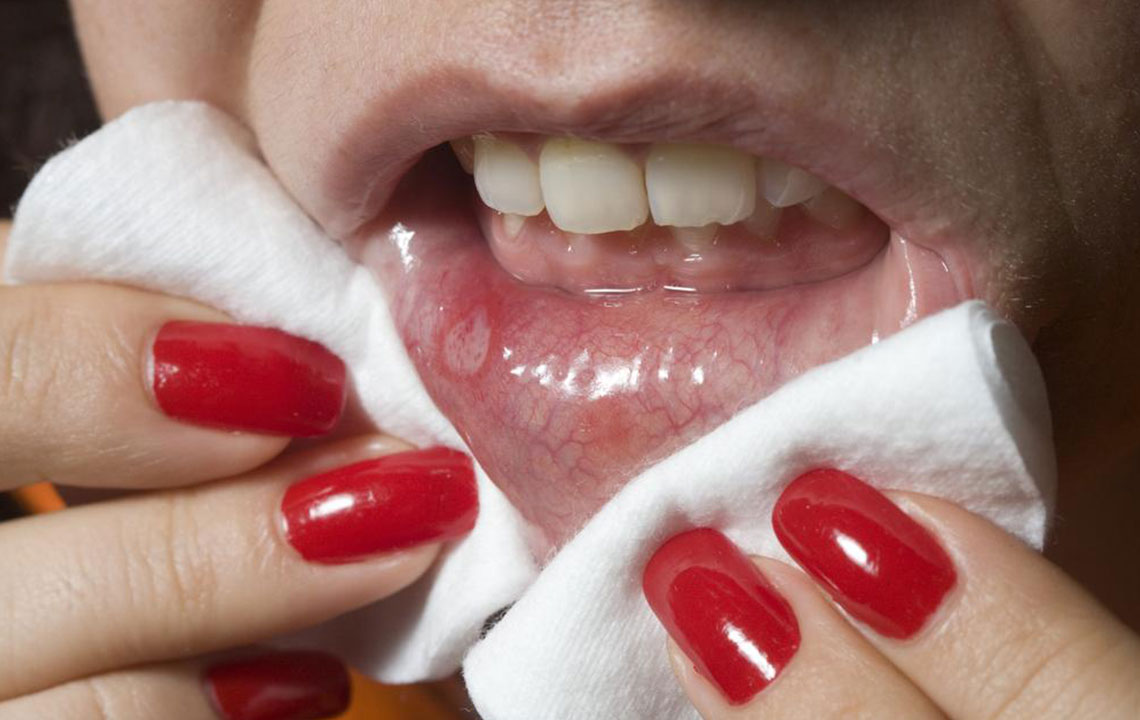 Effective Techniques to Prevent Cold Sore Recurrences