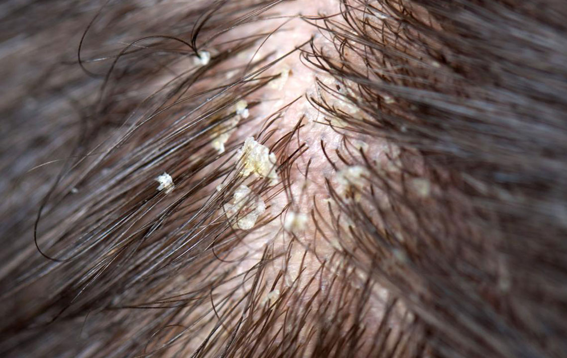 Effective Natural Remedies to Cure Dry Scalp and Promote Healthy Hair