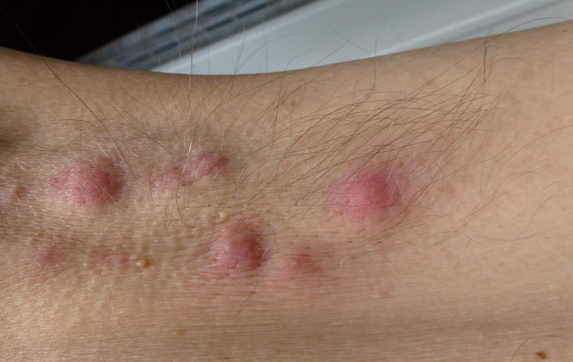 A Complete Guide to Hidradenitis Suppurativa: Symptoms, Causes, and Treatment