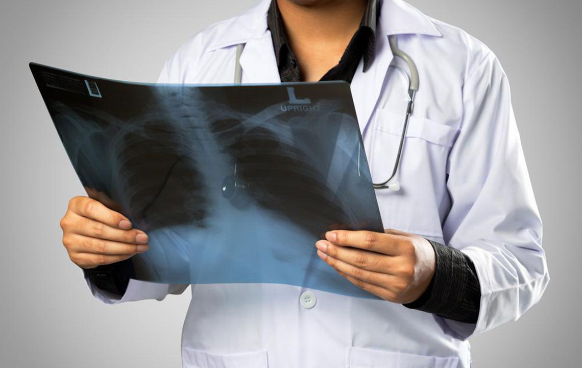 Comprehensive Guide to Metastatic Lung Cancer and Treatment Options