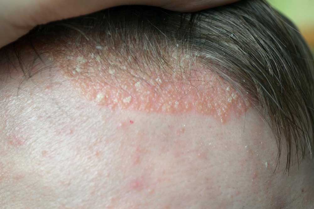 Understanding Scalp Psoriasis: Key Symptoms to Recognize