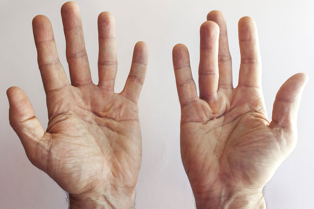 Understanding Dupuytren’s Disease: Symptoms and Causes
