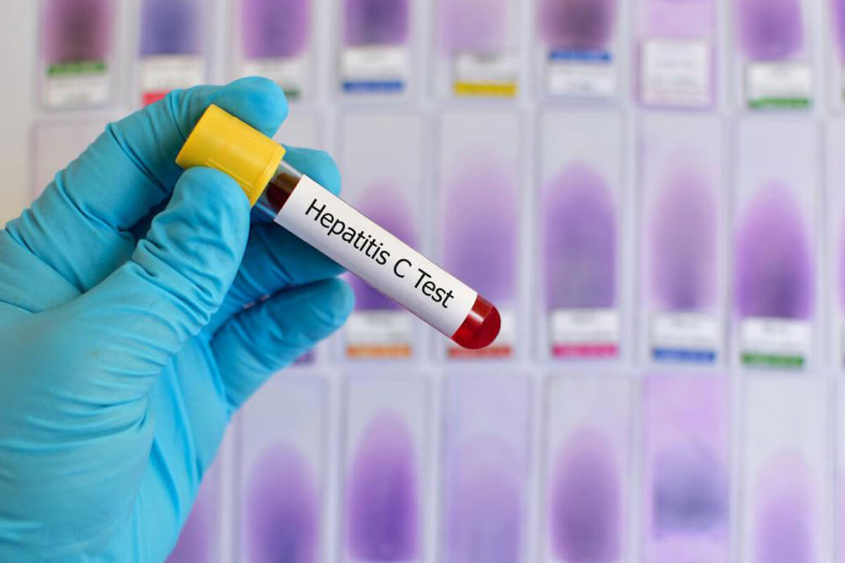 Advancements in Hepatitis C Therapy: What You Need to Know