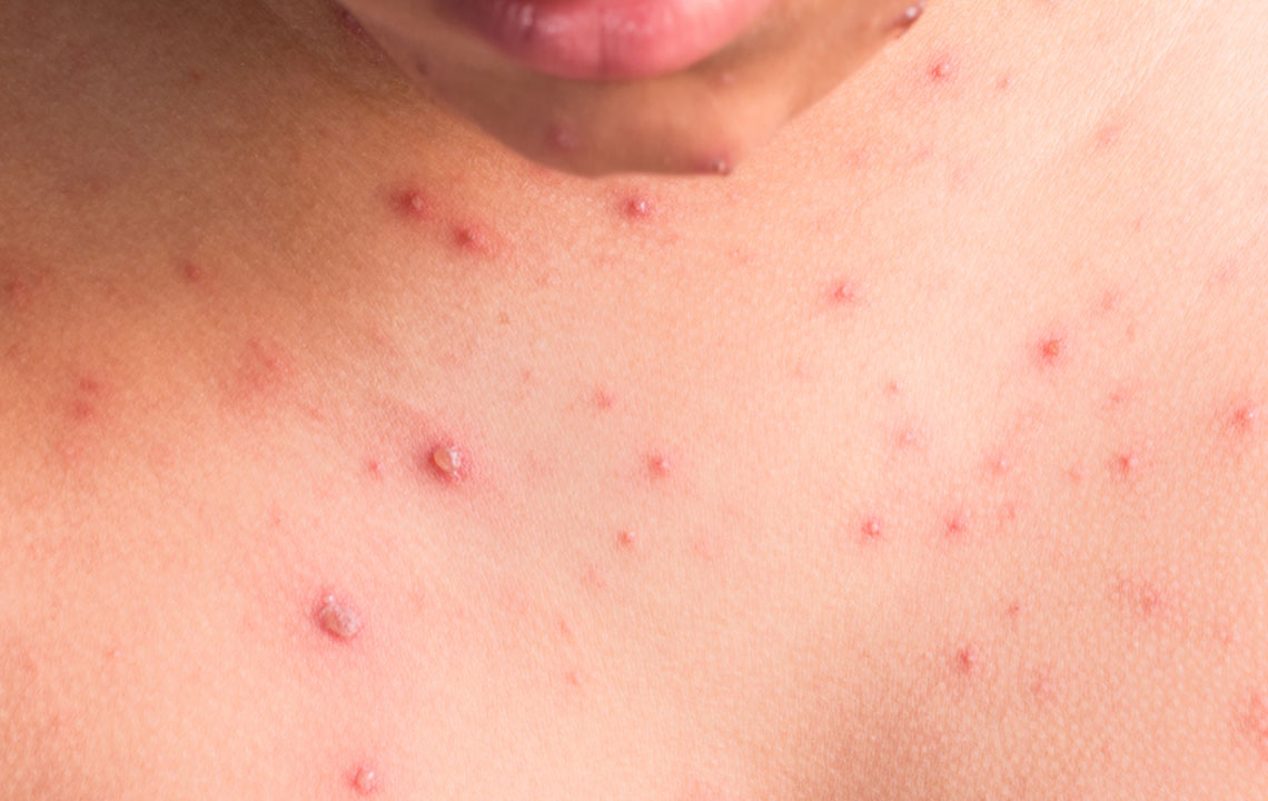 Understanding Tick Bite Rashes: Symptoms, Risks, and Prevention