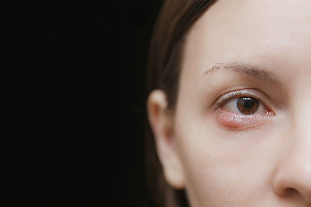 Comprehensive Guide to Effectively Treat and Eliminate Chalazion