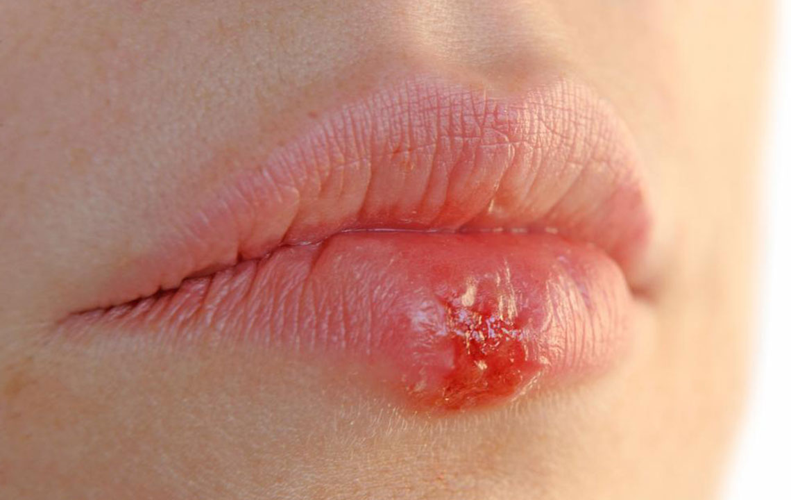 Comprehensive Natural Remedies for Herpes Management: Effective Solutions to Alleviate Symptoms and Prevent Flare-Ups