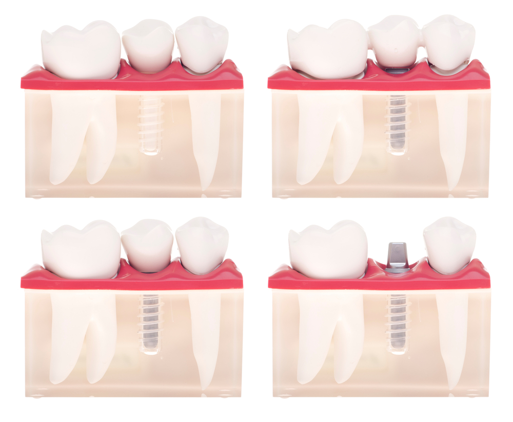 Different Types of Dental Crowns and Their Uses