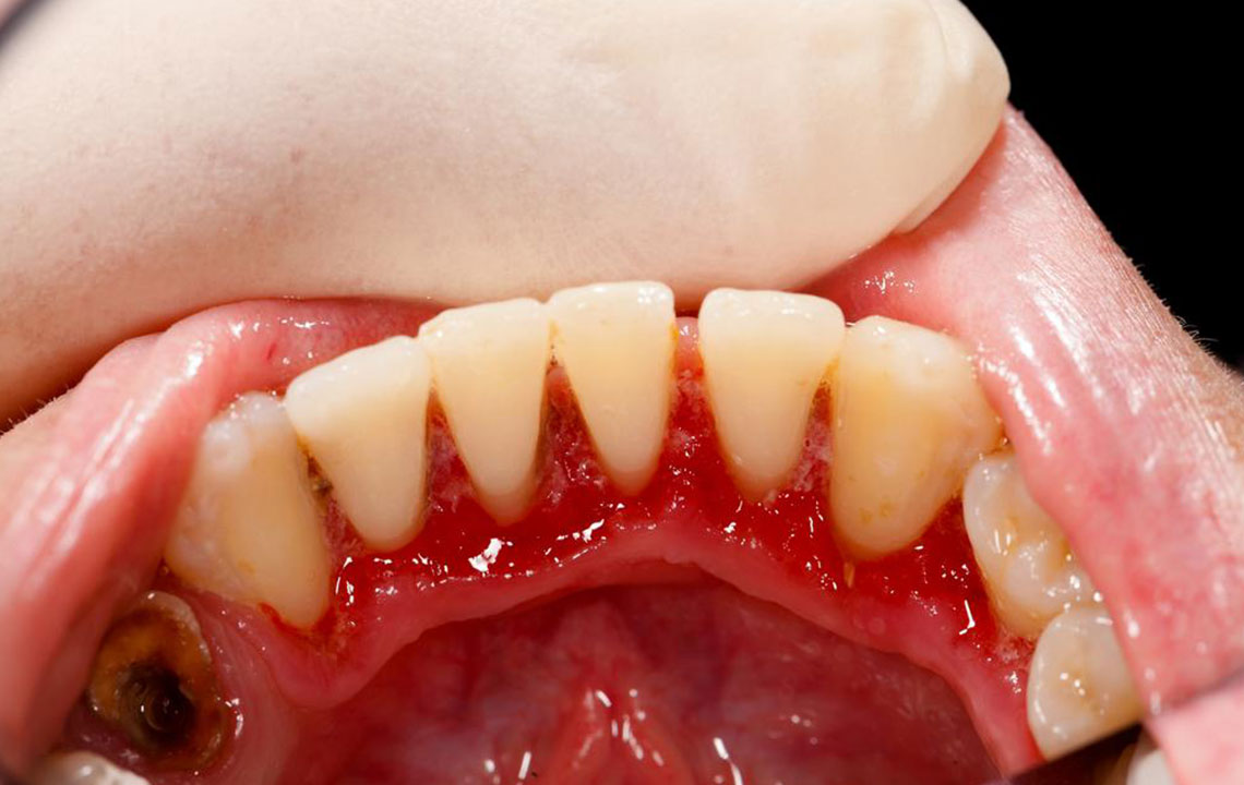 8 Effective Natural Remedies for Gum Health Improvement