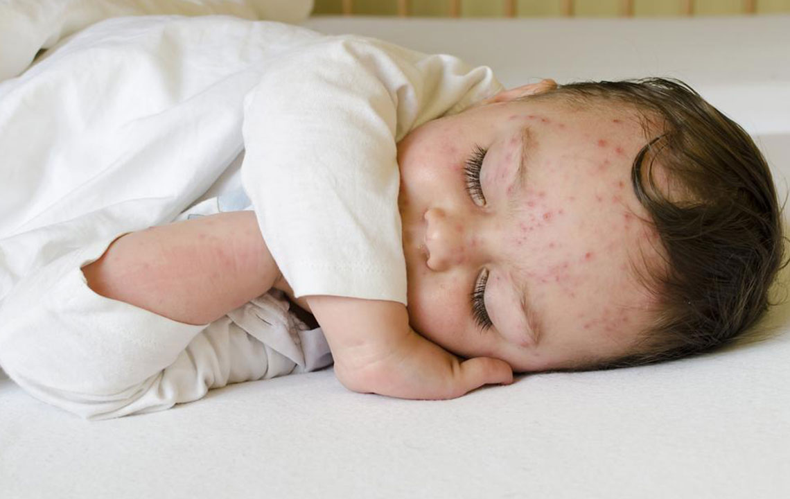 Effective Strategies for Managing Infant Skin Rashes
