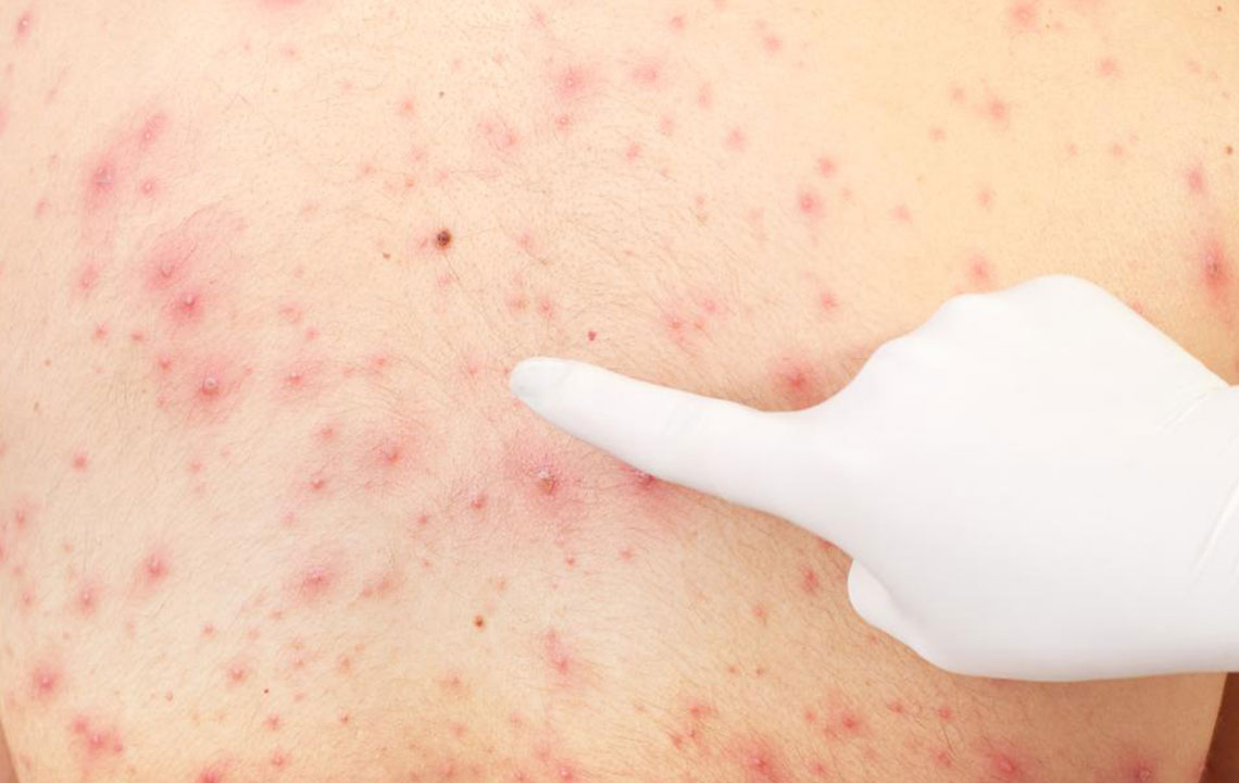 Effective Strategies for Managing Skin Rashes