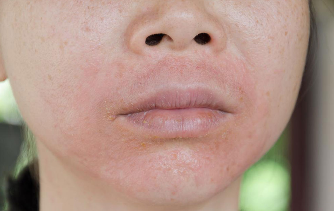 Effective Remedies for Insect Bite Skin Reactions