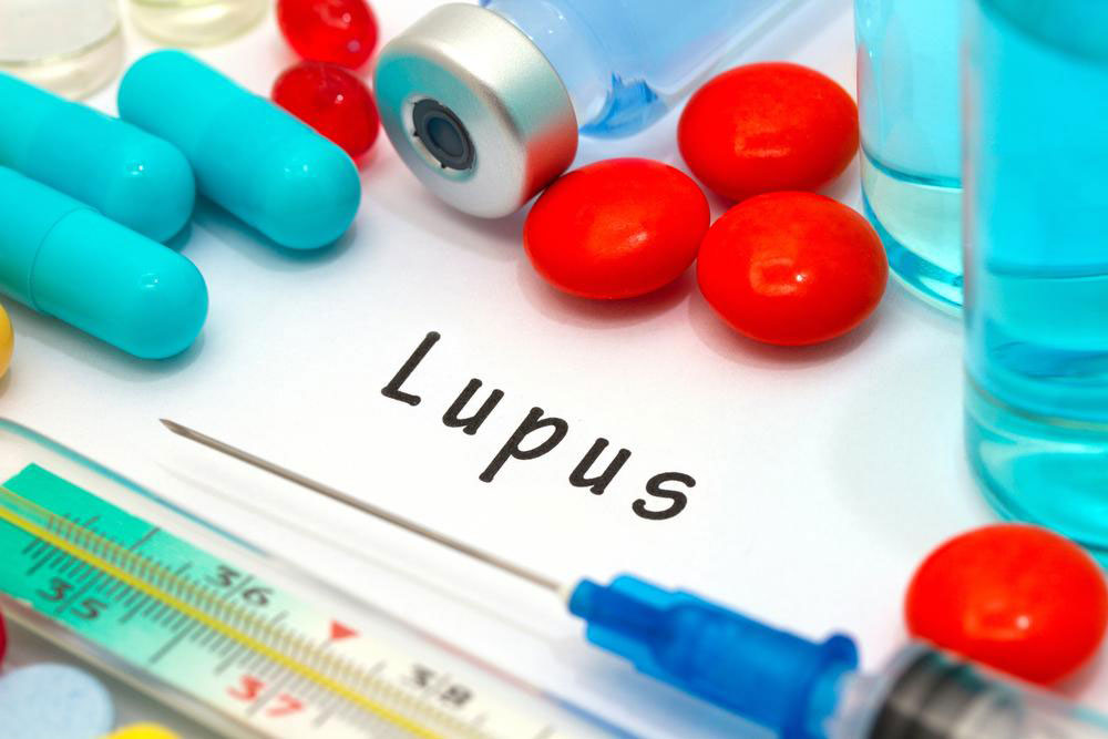 Effective Strategies for Managing Lupus Symptoms