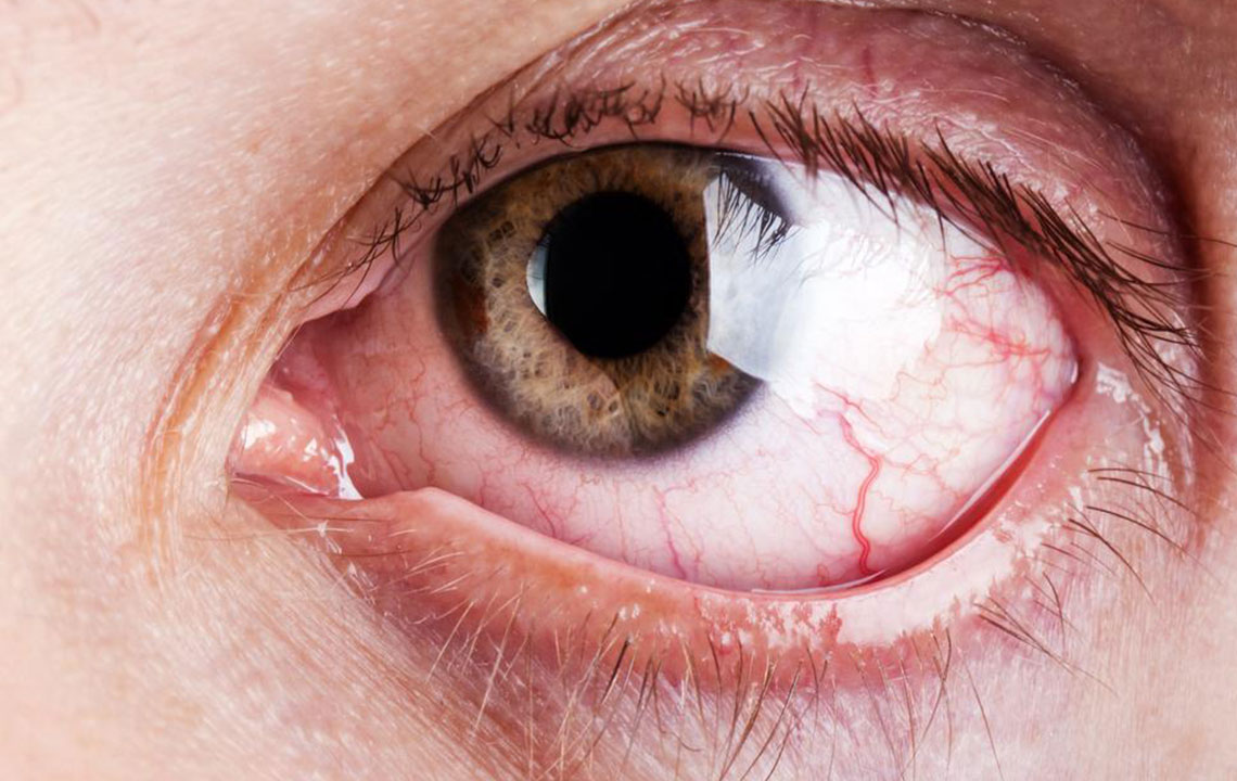 Understanding and Managing Chronic Dry Eye: Causes and Treatments