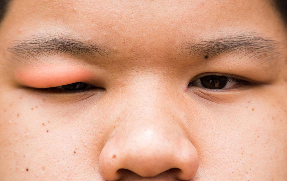 Effective Home Solutions for Common Eye Infections
