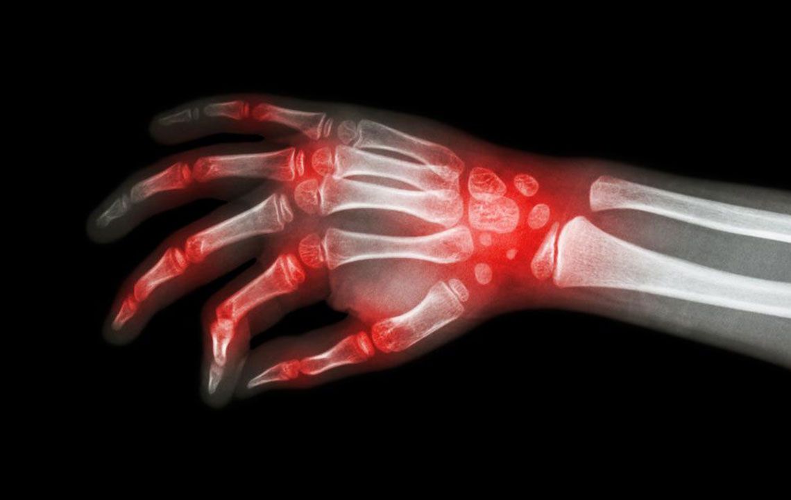 Understanding the Similarities Between Rheumatoid Arthritis and Lupus