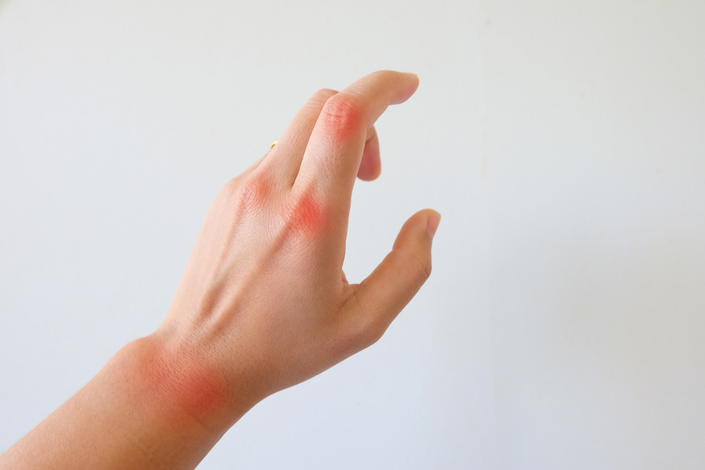 Comprehensive Guide to Effectively Managing Psoriatic Arthritis