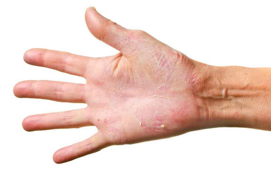 Effective Topical Remedies for Managing Eczema