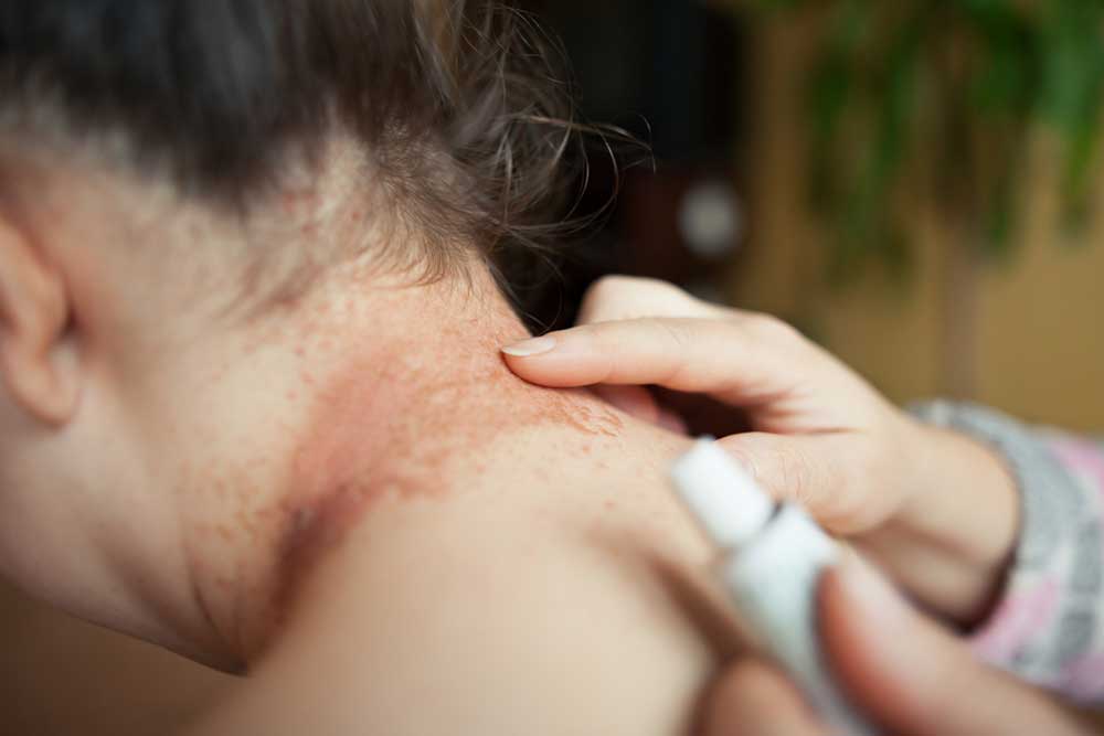 Recognizing the Common Indicators and Symptoms of Eczema