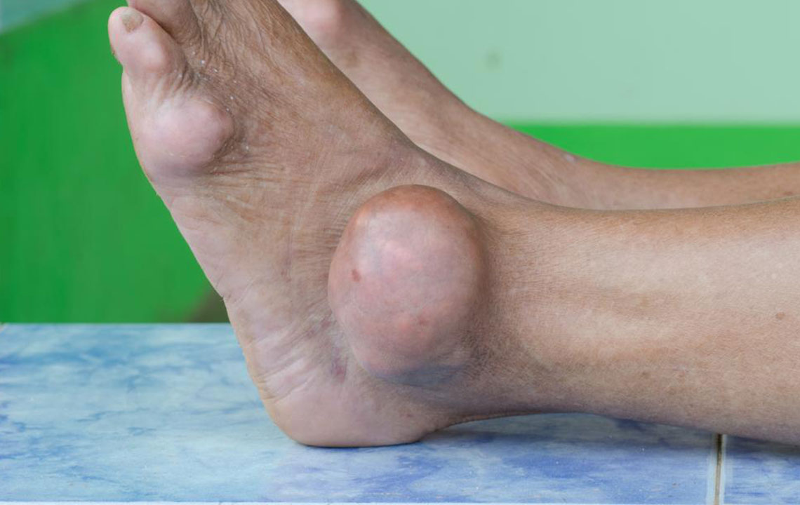 Comprehensive Guide to Preventing Gout-Related Foot Discomfort and Foot Pain Management