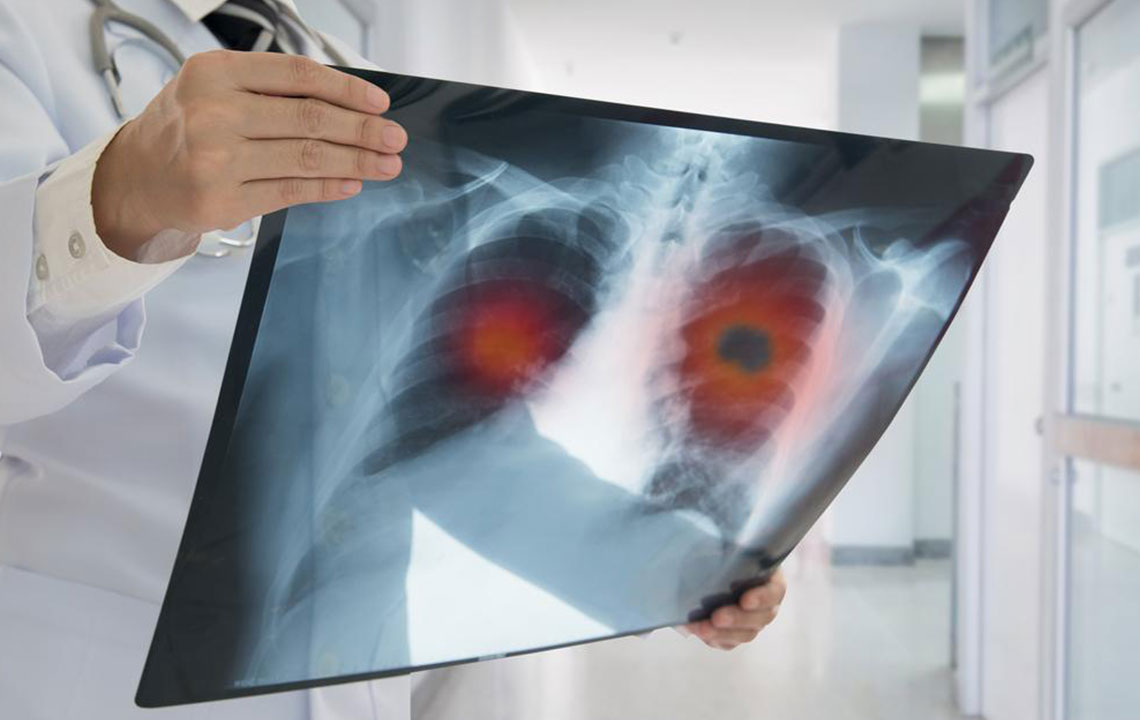 Understanding Non-Small Cell Lung Cancer: Signs and Treatment Options