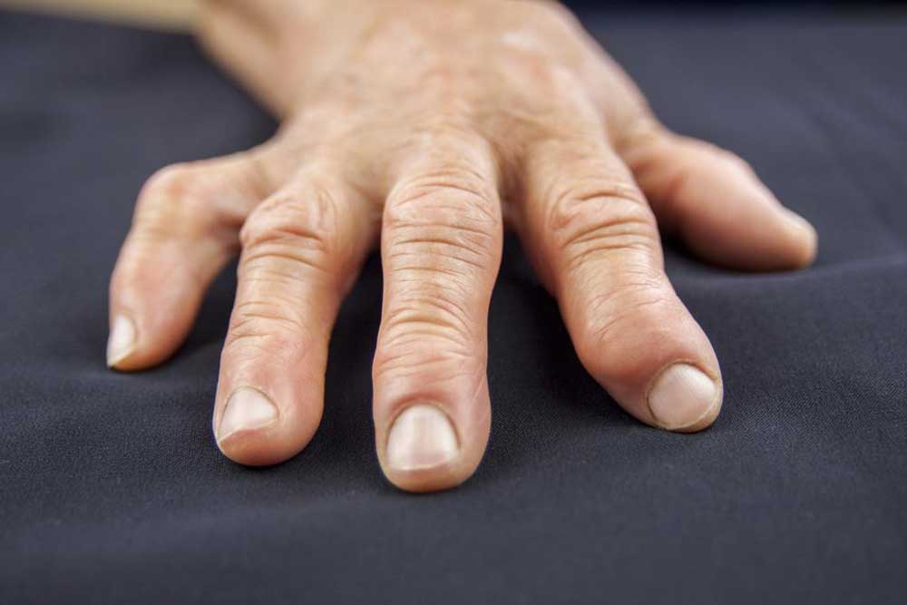 Top 5 Reasons for Finger Swelling You Should Know