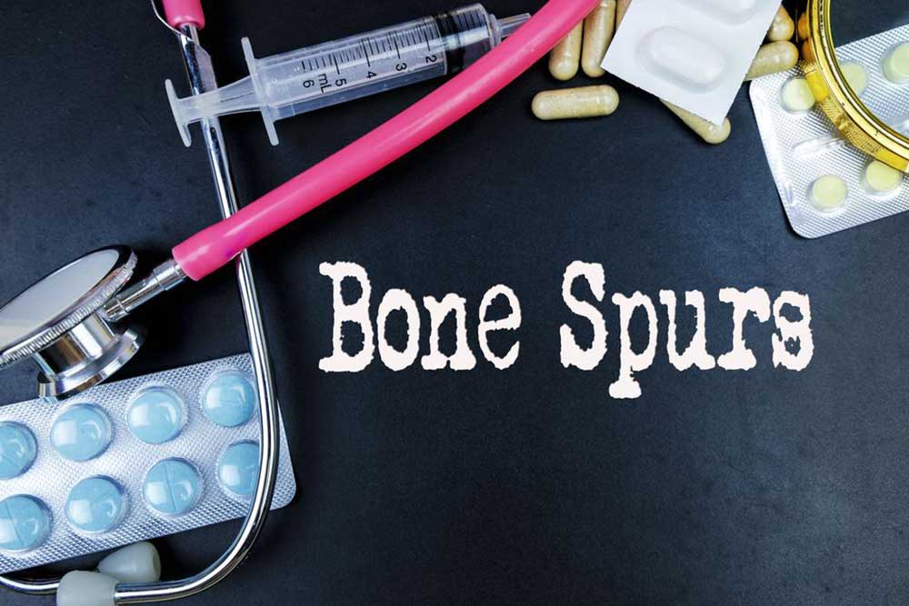Effective Strategies for Preventing and Managing Bone Spurs