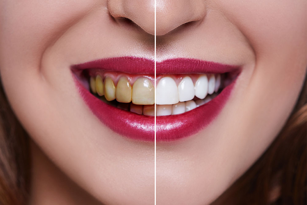 Affordable Dental Veneers: Procedures, Benefits, and Pricing Insights