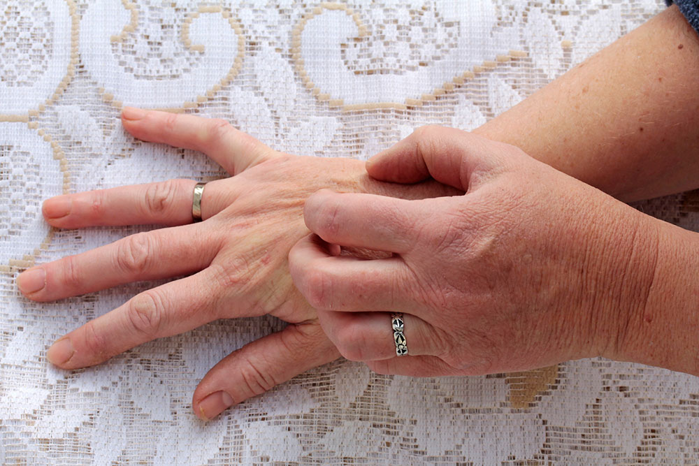 Understanding Scabies: Symptoms, Causes, and Treatment Strategies