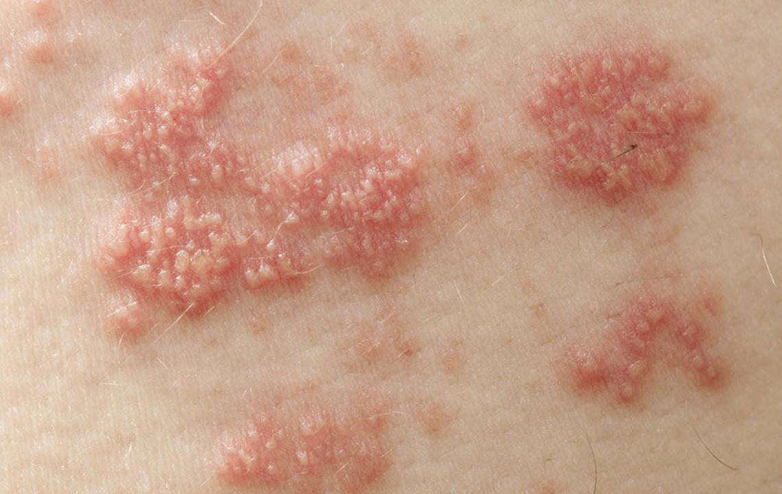 Effective Strategies and Remedies for Managing Shingles