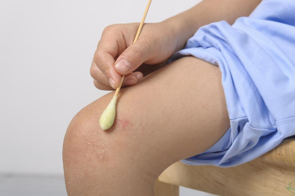 Effective Natural Remedies for Rapid Relief from Hives Symptoms