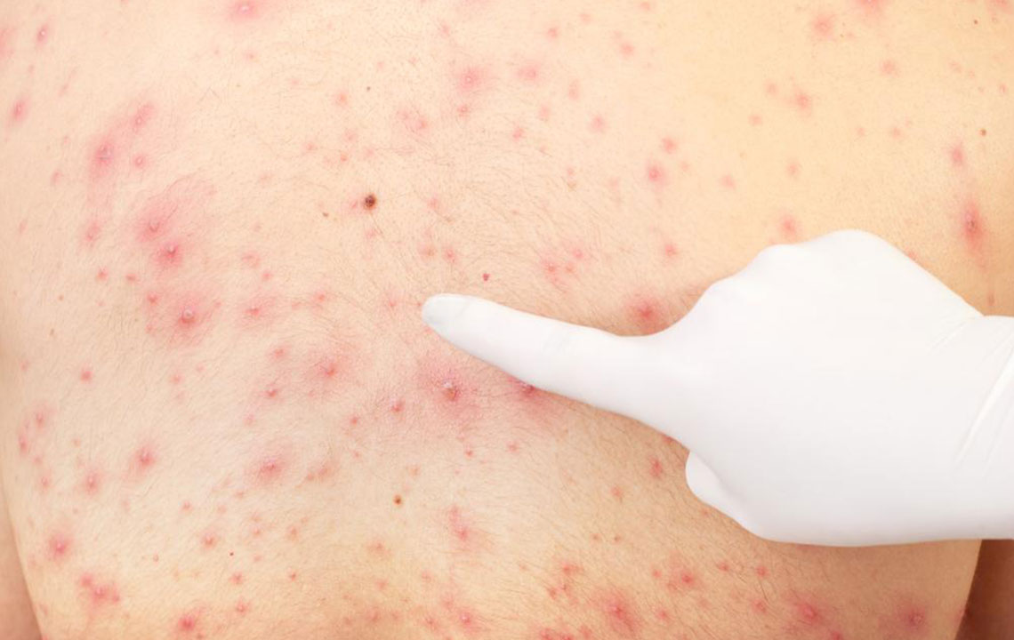 Effective Home Remedies for Keratosis Pilaris