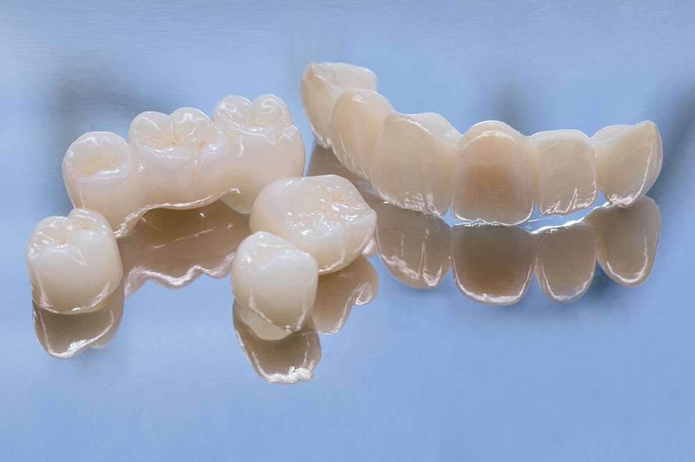Essential Insights Before Choosing Dental Bridges