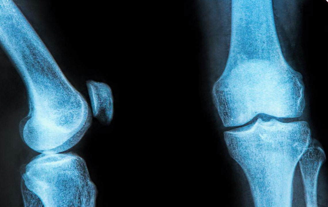 Essential Insights on Knee Support for Meniscus Injuries