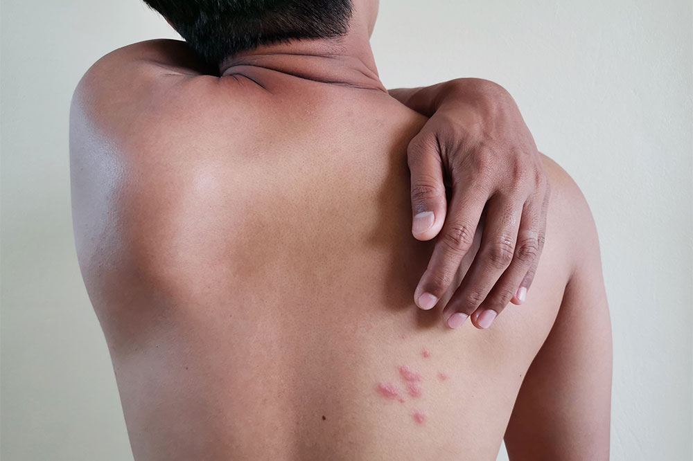 Understanding Shingles: Treatments and Preventive Strategies